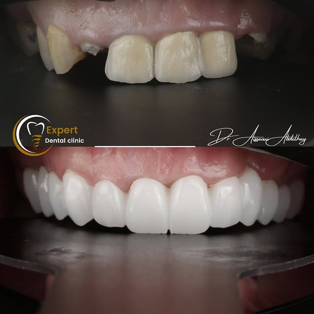 Blanchiment des dents