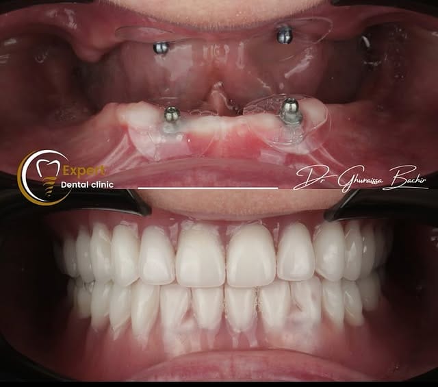 Pose d'implants dentaires par des spécialistes