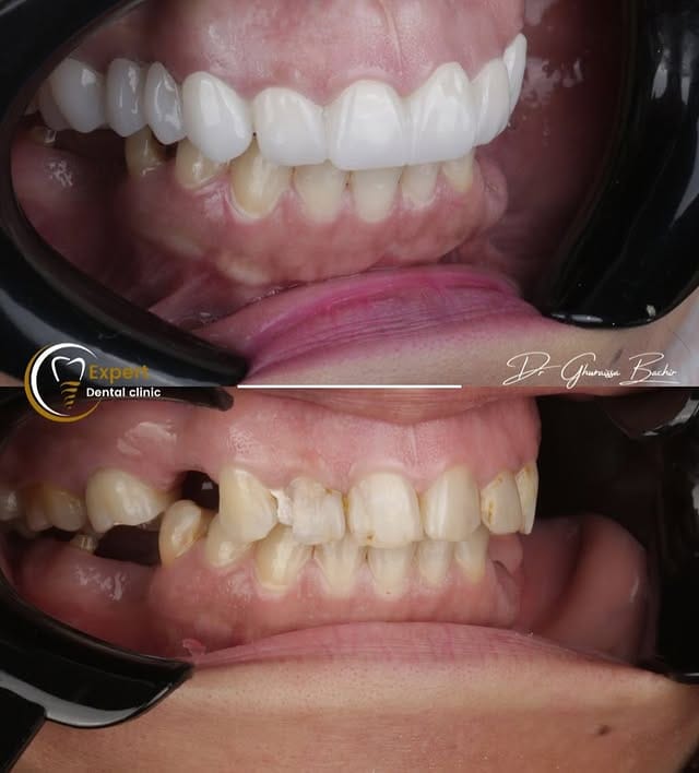 Blanchiment des dents